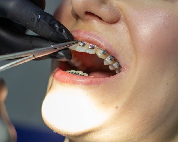 Orthodontie chez l'adulte dents alignement gencives