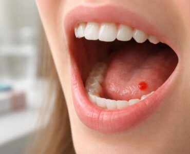 découvrez les causes possibles d'un point de sang dans la bouche, les symptômes associés et les conseils pratiques pour agir rapidement et efficacement.